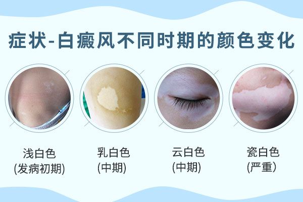 十强医院！江西“南昌”治面部白癜风医院排名更新,南昌白点癫风医院哪家最-好?