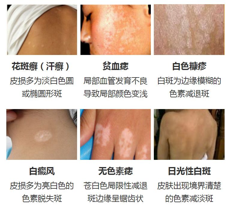 TOP10指南！南昌看白癜风上榜医院-治疗白斑最-好的医院?