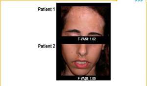 南昌去哪里能看白癜风-白癜风临床试验受试者招募